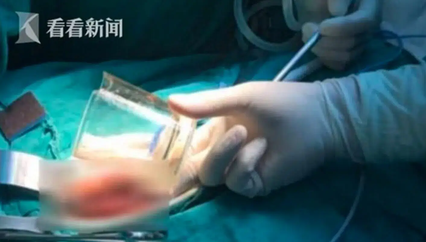 Paciente é submetido a uma cirurgia após copo ficar preso em ânus