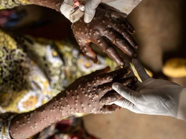 Moçambique alerta para surto de Mpox com 96 casos suspeitos e 17 confirmados