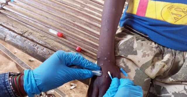 Zambézia reforça vigilância após suspeitas de casos de Mpox no distrito de Milange