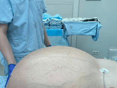 Médicos russos extraem tumor gigante de mais de 60 quilos