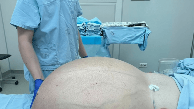 Médicos russos extraem tumor gigante de mais de 60 quilos
